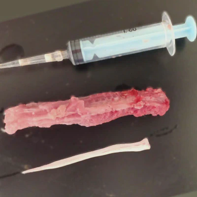 Spinal cord isolation by hydraulic extrusion.